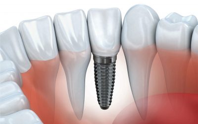 Questions About Dental Implants and Cleanings