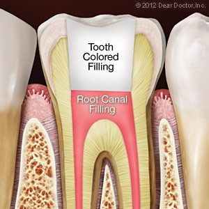 Do You Need A Root Canal?