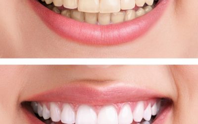 Top 3 Reasons to Whiten Your Teeth