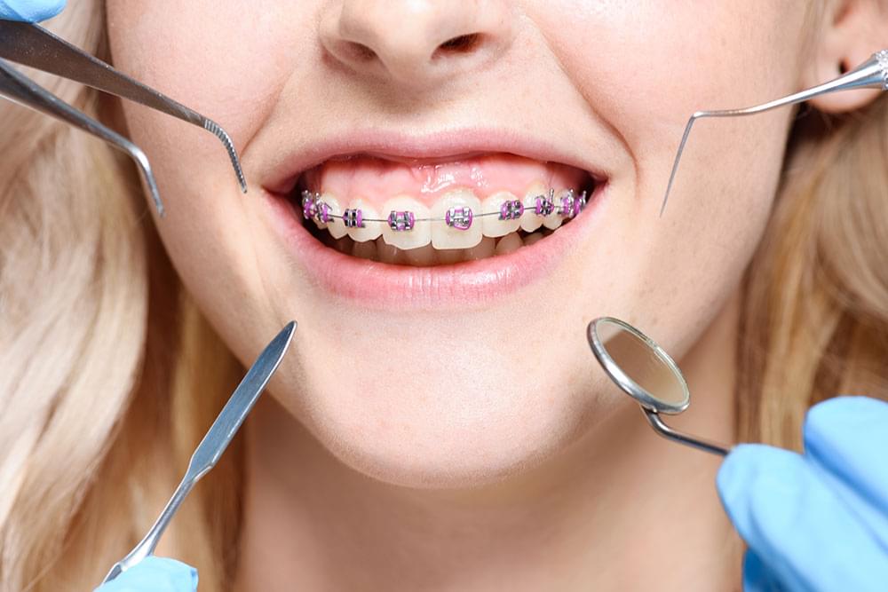 Top Benefits Of Orthodontic Treatment | West Cobb Dentistry