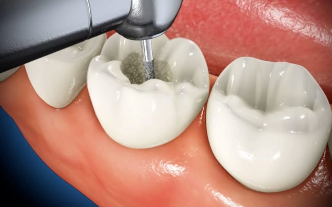 Endodontic Treatment, Root Canal Procedure